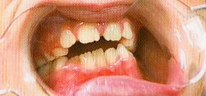 Fogszab.kivehető készülék._1